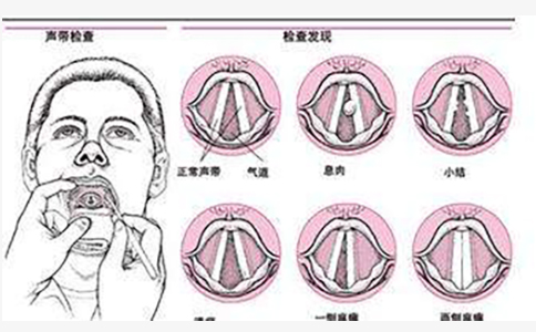 声带息肉7