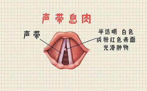声带息肉6
