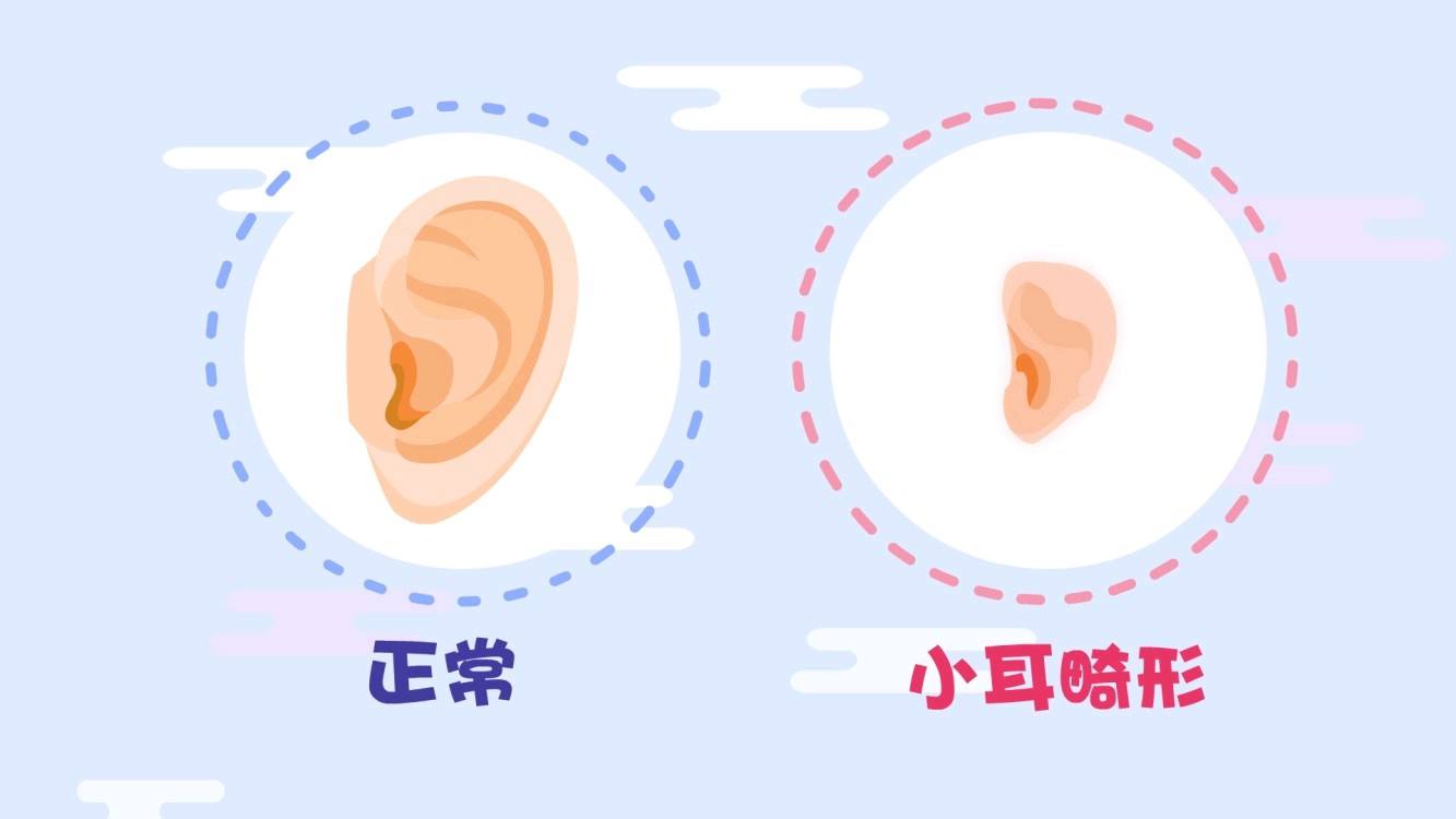 先天性小耳畸形