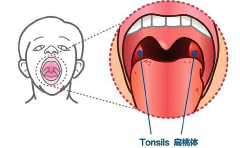 扁桃体炎