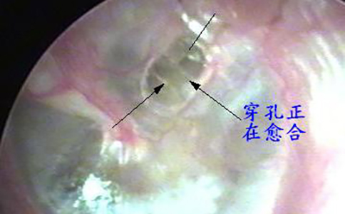 鼓膜穿孔