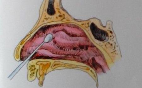 鼻腔囊肿