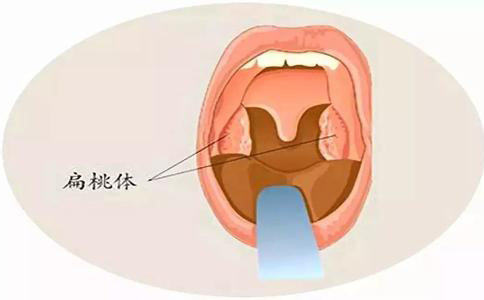 扁桃体炎