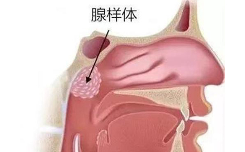 腺样体肥大