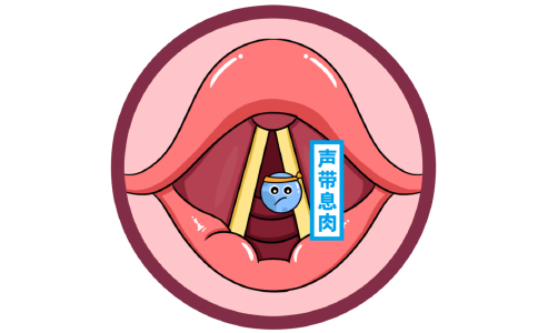 声带息肉