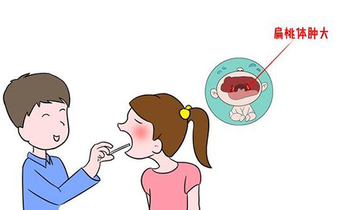 扁桃体肥大