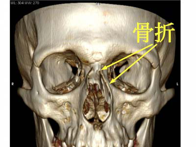 鼻骨骨折
