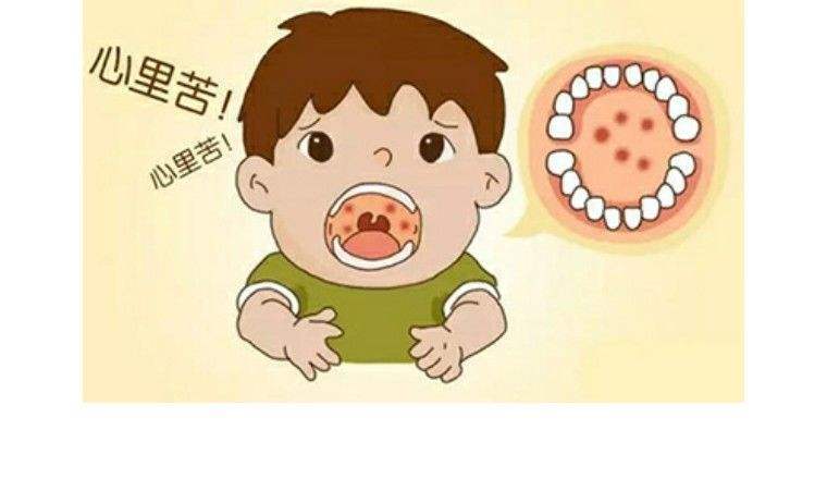 疱疹性咽峡炎