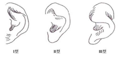 小耳畸形