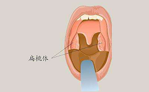 扁桃体炎