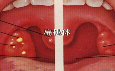 扁桃体肿大