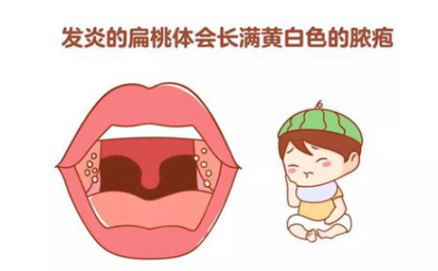 急性扁桃体炎