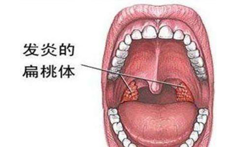 扁桃体炎