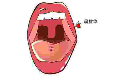 扁桃体肥大